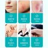 Curativo de Hidrocoloide Kefu, Curativo Adesivo Impermeável, Pele Artificial, Curativo para Queimaduras Úmidas e Escaldões, Curativo para Acne