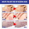 Spray Calmante para Dermatitis South Moon Cuidado para Dermatitis en Manos y Pies Cuidado de la Piel Spray para Cuidado Anti-Hinchazón