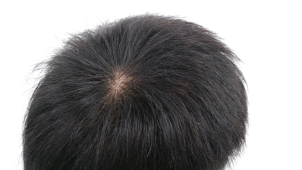 全手织男士秃顶假发,逼真透气遮秃顶真人发头套