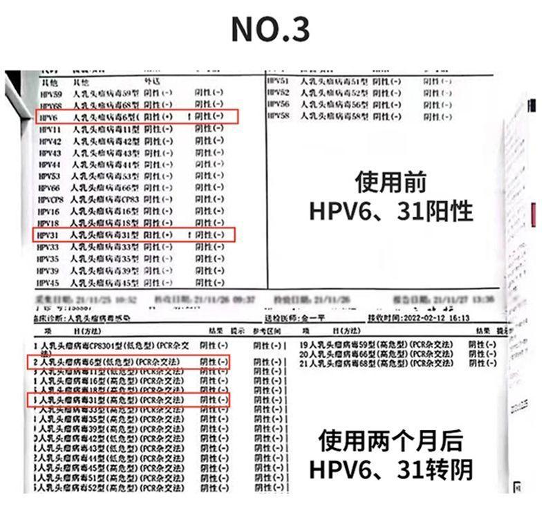 珺普惠医用抗HPV生物蛋白功能敷料病毒干扰素凝胶降低载量妇科阴