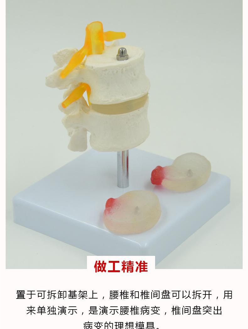 两节腰椎带椎间盘病变