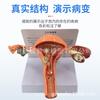 Modelo anatómico patológico del útero reproductor femenino humano. Modelo didáctico del ovario vaginal. Material didáctico sobre reproducción ginecológica.