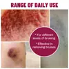 Crema para Hematomas de Comercio Exterior Crema Hidratante Crema Transfronteriza para Hematomas Mejora la Hinchazón Muscular, el Dolor y los Hematomas en Manos y Pies