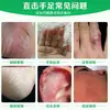Ungüento Personalizado para el Cuidado de la Salud por Congelación en Manos y Pies Oem Oreja Cara Manos y Pies Secos Agrietados Congelación Congelación Ungüento Anti-Picazón Congelación Ungüento