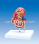 肾脏囊肿解剖模型病理模型