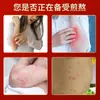 Crema de Cuidado con Vitamina B6 20g Ampollas de Acné Anti-Picazón Peeling de Manos y Pies Ungüento Anti-Picazón Ungüento para Piel de Gallina Venta al por Mayor