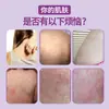 Crema Anti-Picazón para Uso Externo en la Piel, Rey Anti-Picazón para Picazón Seca y Cuidado Corporal, Uso Externo en la Superficie de la Piel, Ungüento Anti-Picazón