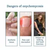 Solução para Cuidado de Unhas Ximonth para Unhas Encravadas e Espessadas, Solução para Cuidado de Unhas das Mãos e Pés