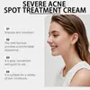 Creme para Cuidados com a Pele Vorvita Cuida da Pele do Rosto Propensa à Acne, Deixando-a Lisa, Macia e Delicada. Aplicação Diária do Creme