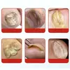 Caneta onicomicose creme para unha 5ml/peça, caneta de cuidado para unhas dos pés e mãos, gel de aplicação externa, em estoque