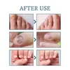 Solução para Cuidado de Unhas Ximonth para Unhas Encravadas e Espessadas, Solução para Cuidado de Unhas das Mãos e Pés