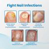 Gel reparador onicomicosis Ximonth reparación uña encarnada uña blanda podrida tipo engrosamiento alivio del dolor cuidado de limpieza