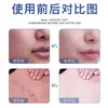 Dr. Essência de Limpeza de Folículo Piloso para Acne L Shuomei, Hidratante e Umectante, Melhora a Pele com Tendência à Acne, Repara e Suaviza a Pele, Entrega Direta do Fabricante