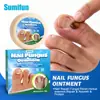 Sumifun Comércio Exterior Transfronteiriço Pomada Fitoterápica para Cuidado do Sulco da Unha, Creme Hidratante Diário para Pele ao Redor da Unha K920021
