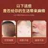 Ungüento Veneno de Lobo Shuo Jian Farmacéutico para Uso Externo en Piel con Picazón, Bultos y Piel Descamada en Manos y Pies, Hecho a Medida para el Cuidado de la Salud