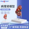 Modelo de Riñón Patológico, Modelo de Riñón, Modelo de Vísceras Humanas, Anatomía Renal Natural, Espécimen de Modelo de Glándula en Forma de Riñón
