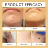 WIYUN veneno de abelha para você creme para cuidados com a pele de toupeira creme de ervas suave para clareamento da pele de toupeira creme para cuidados com a pele