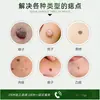 Eliminación de Lunares, Eliminación de Verrugas, Crema para Eliminar Lunares, Fórmula Herbal Personalizada de Origen Vegetal, Líquido para Eliminar Lunares, Eliminación OEM de Verrugas y Lunares