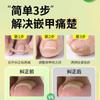 Ortesis para uñas encarnadas de los pies, parche rápido para la deformación de las uñas de los pies
