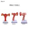 Modelo patológico uterino femenino estructura uterina ovárica materna y reproductiva Anatomía simulación avanzada modelo uterino mórbido