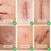 Venta Directa de Fábrica Yiwu Parche Invisible para Cicatrices de Piel, Parche Camuflaje Color Piel, Parche Reparador de Cicatrices de Tatuajes