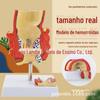 Modelo de Lesão de Hemorroida Retal, Anatomia Interna e Externa das Hemorroidas e Modelo de Patologia Colorretal