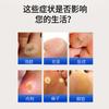 Ungüento de Ojo de Pollo Biotecnológico de Li Shizhen para el Cuidado de los Pies, Eliminación de Piel Muerta, Callos y