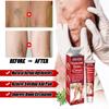 ERAYCEE transfronterizo Temu joom vena Shu crema para la salud Shu Huo de hierbas para la vena verde Qu Zhang abultamiento