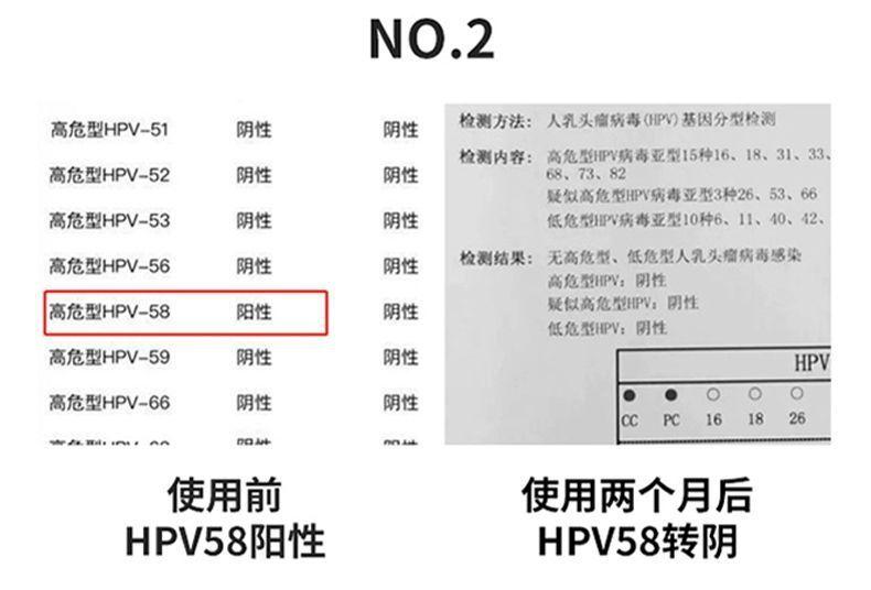 珺普惠医用抗HPV生物蛋白功能敷料病毒干扰素凝胶降低载量妇科阴